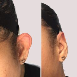 BANDA PARA LA CABEZA con soporte de adhesivo (COLOR: NEGRO)  mejora la apariencia de las orejas de forma gradual SIN DOLOR